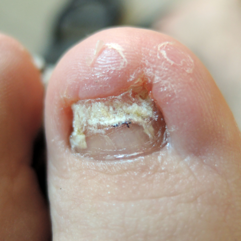 a fungal infected nail
